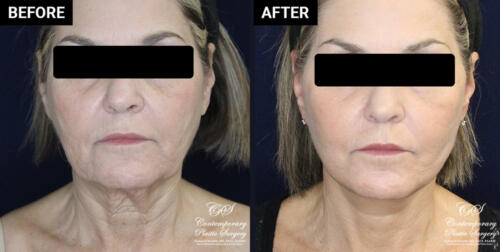 lower face and neck lift patient results at Contemporary Plastic Surgery
