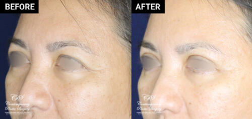 eyelid surgery patient before and after results at Contemporary Plastic Surgery