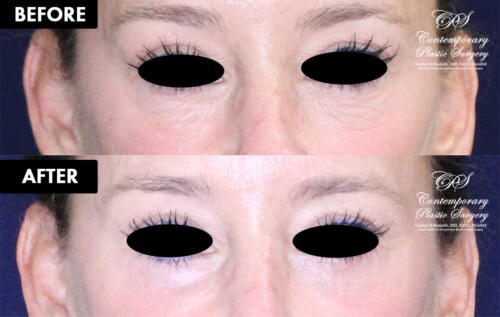 Eyelid surgery patient results at Contemporary Plastic Surgery