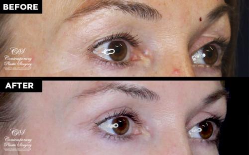 blepharoplasty patient before and after results at Contemporary Plastic Surgery