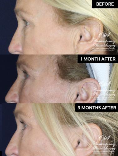 Eyelid surgery patient before and after results at Contemporary Plastic Surgery