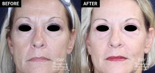 upper and lower blepharoplasty before and after results