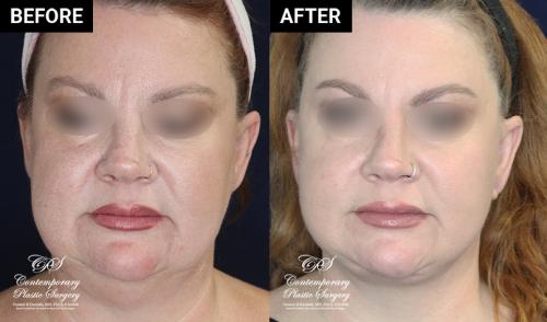patient 19644 before and after results at Contemporary Plastic Surgery
