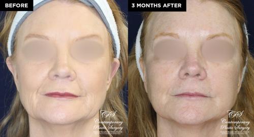 patient 19677 before and after Contemporary Lift results at CPS
