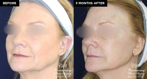 patient 19677 before and after Contemporary Lift results at CPS