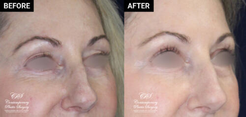 eyelid surgery patient before and after results at Contemporary Plastic Surgery