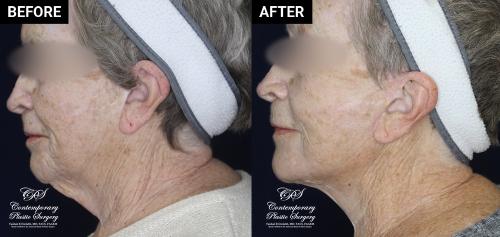lower face and neck lift before and after results at Contemporary Plastic Surgery