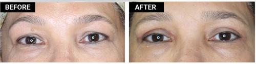 eyelid surgery patient before and after