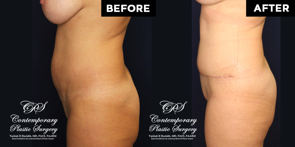 Tummy tuck patient results at Contemporary Plastic Surgery