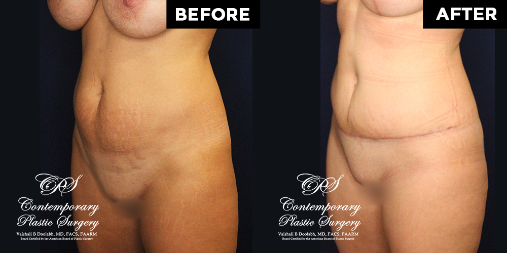 Tummy tuck patient results at Contemporary Plastic Surgery