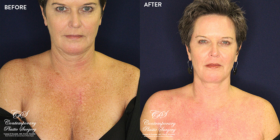 laser treatment patient before and after