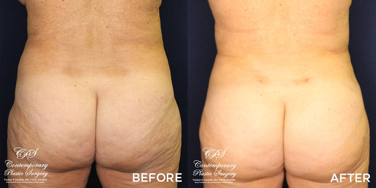 liposuction & Renuvion