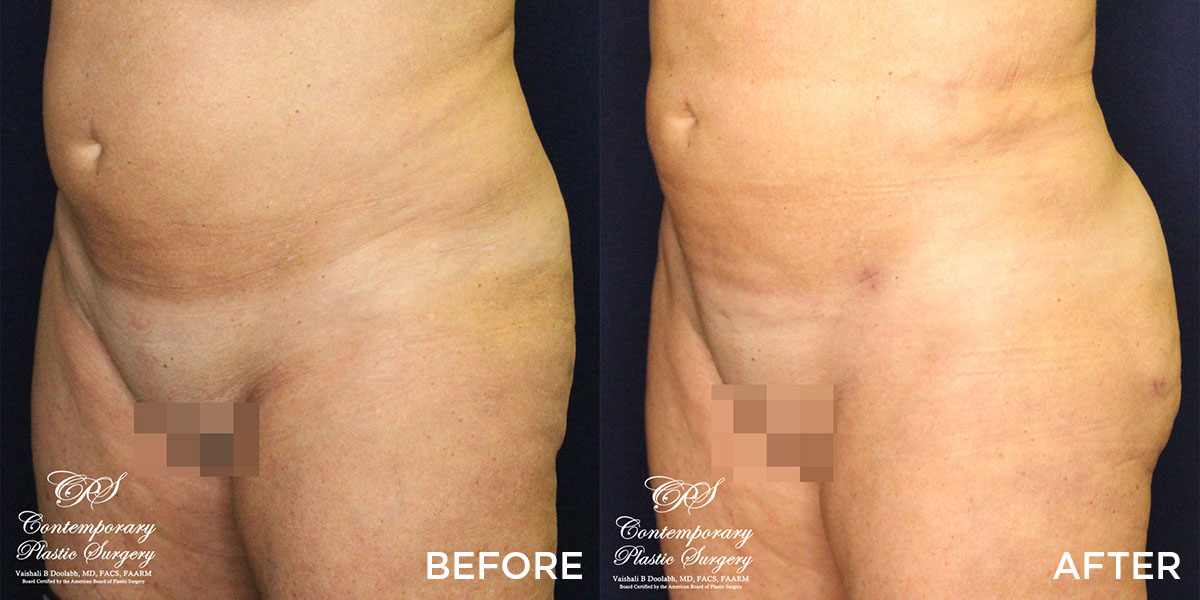 VASER liposuction & Renuvion