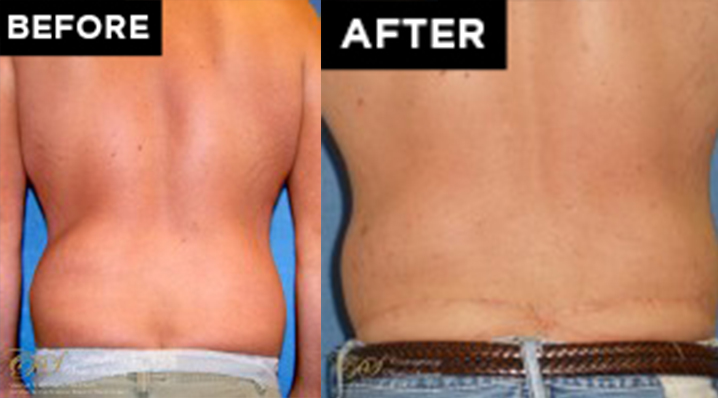 body lift patient before and after