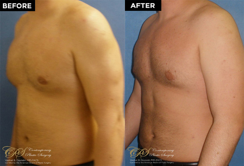 male body contouring before and after