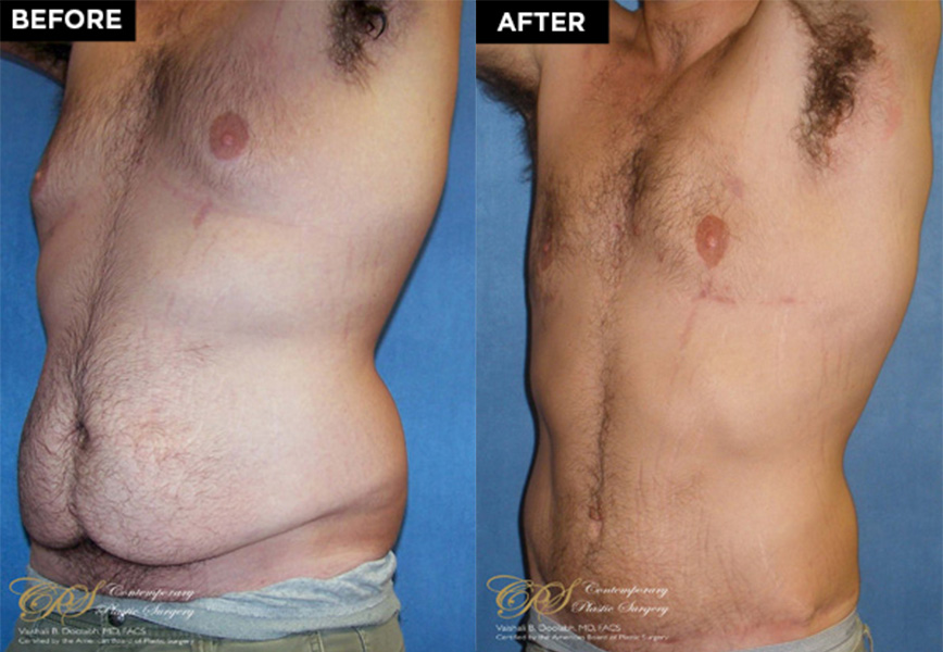 male body contouring before and after
