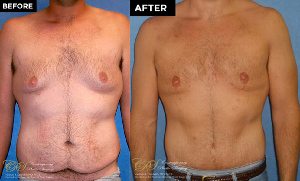 male breast reduction patient before and after