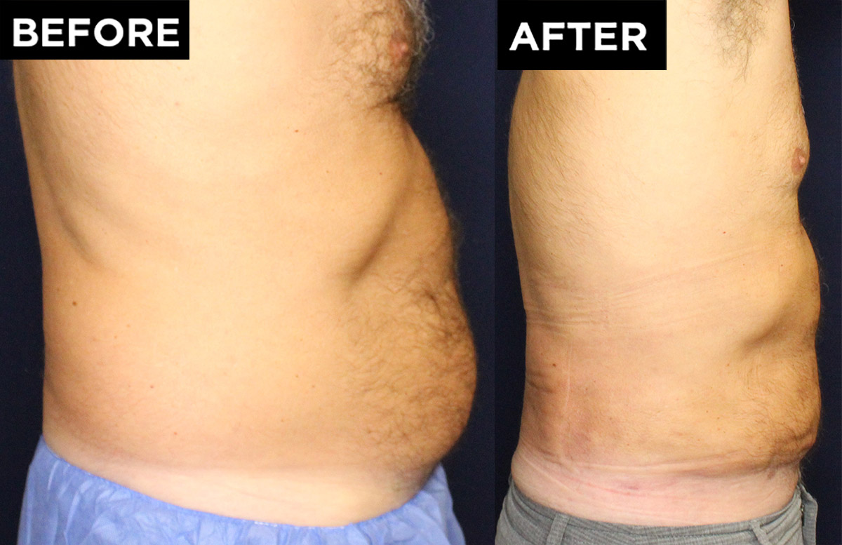 Liposuction and Renuvion before and after