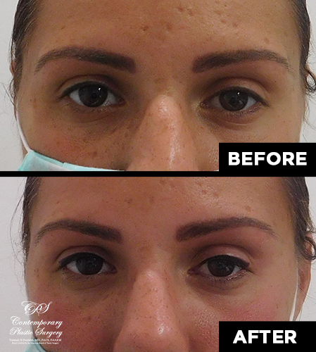 permanent makeup patient results at Contemporary Plastic Surgery