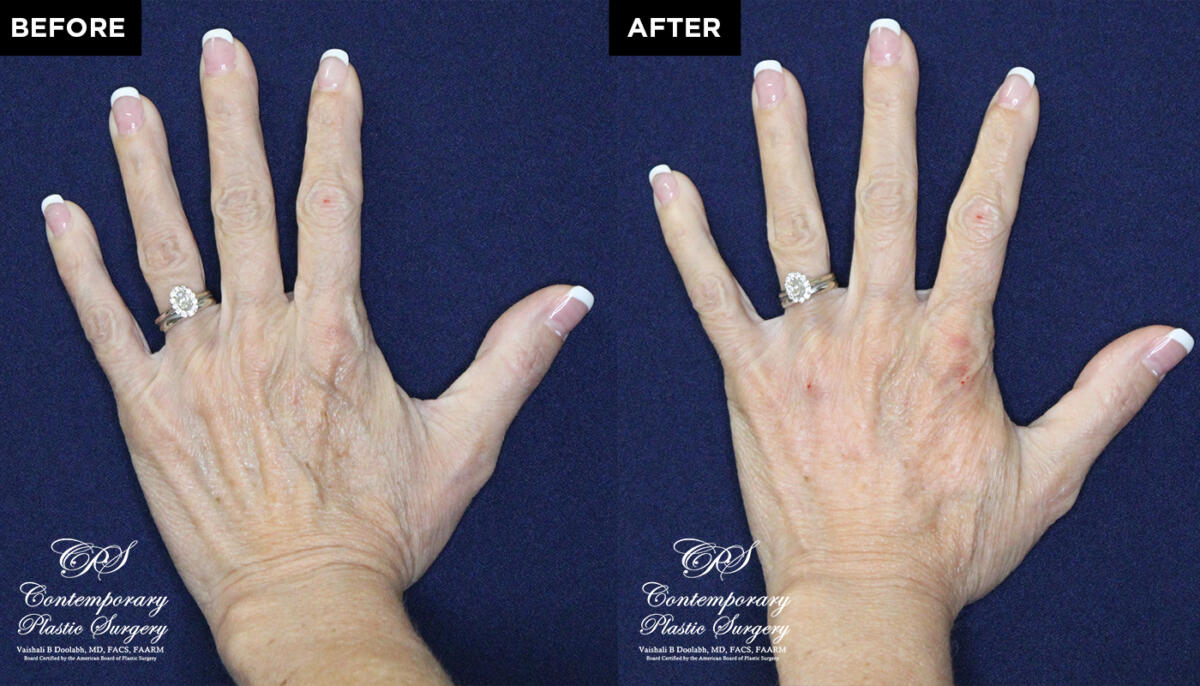 patient before & after Radiesse injections at Contemporary Plastic Surgery