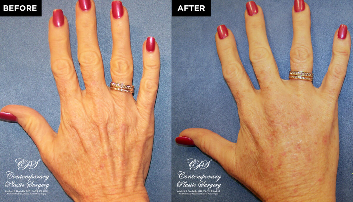 patient before & after Radiesse injections at Contemporary Plastic Surgery