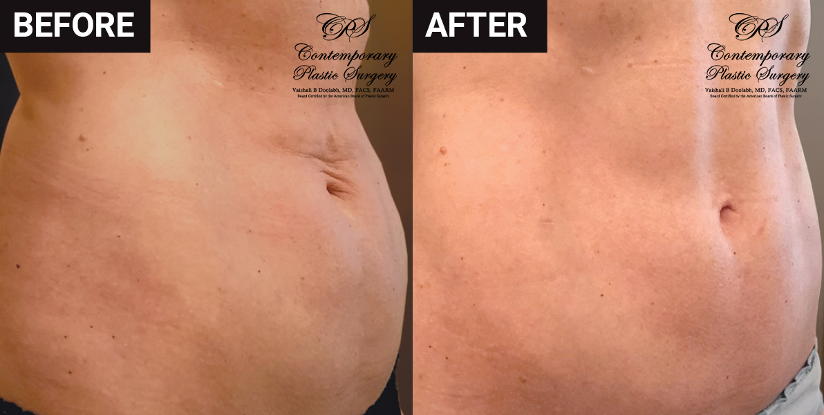 liposuction and Renuvion® before and after results at Contemporary Plastic Surgery