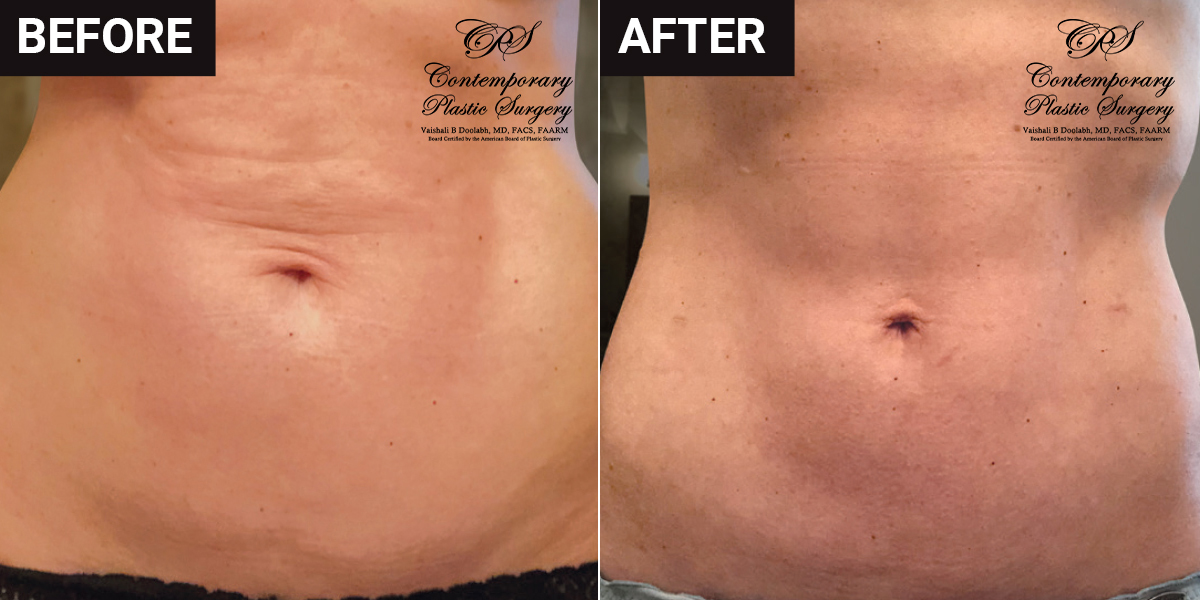 liposuction and Renuvion® before and after results at Contemporary Plastic Surgery