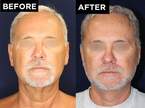 face lift before and after