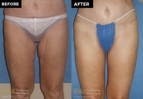 thigh lift patient before and after