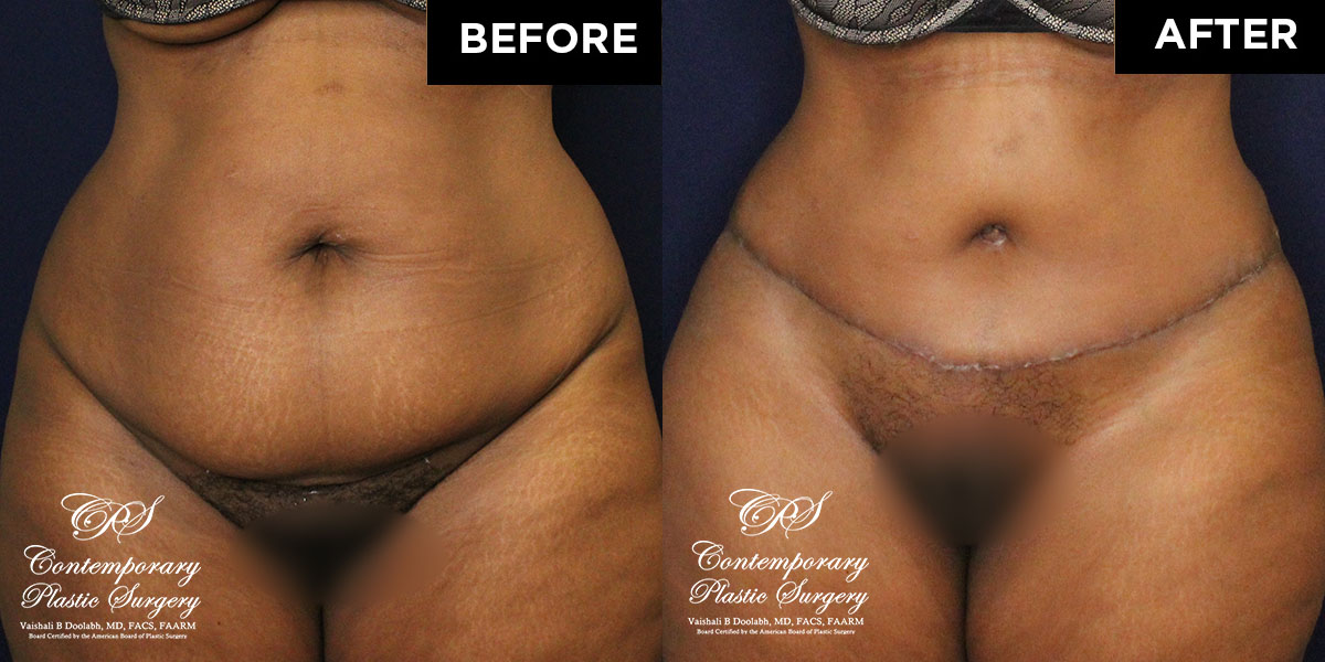 drainless tummy tuck abdominoplasty patient before (JJ-12302019)