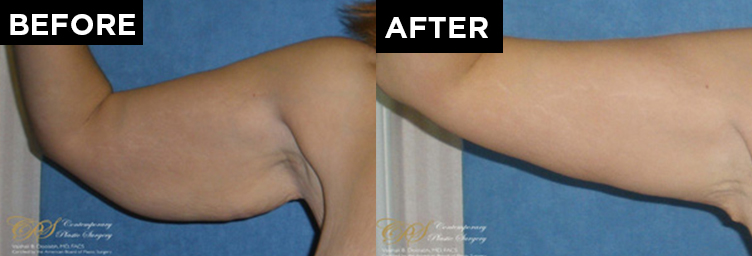 patient arm before & after arm lift